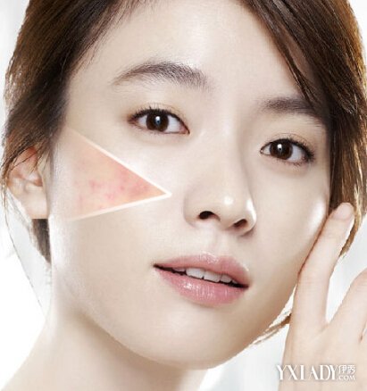 【图】激光祛痘怎么样 激光祛痘副作用有哪些