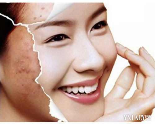 【图】怎么能去除青春痘 教你几个方法快速去