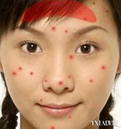 【图】青春痘长在不同位置反映不同健康问题 