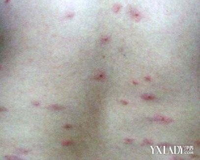 【图】红斑和丘疹的图片 红斑和丘疹的各种症状