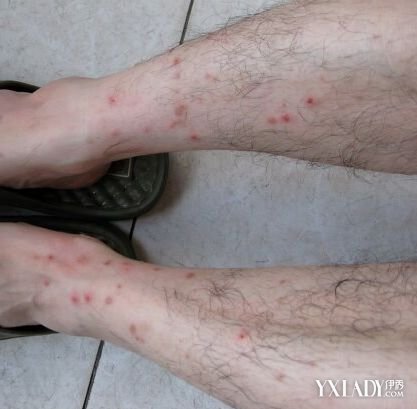 【图】红斑和丘疹的图片 红斑和丘疹的各种症状