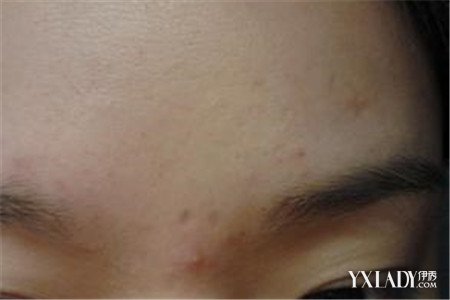 【图】右眼眉毛里面长痘痘是什么导致 教你有