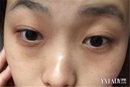 【图】熬夜哭过有黑眼圈怎么消除 六招教你有