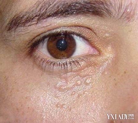 眼部扁平疣发危害有哪些 为你浅析扁平疣的3个症状