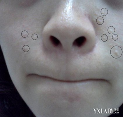 【图】脸上脂肪粒怎么去掉 高手支招6种有效的