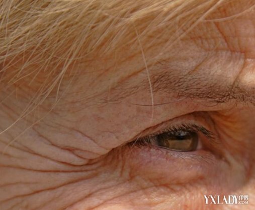 【图】鱼尾纹除皱术要注意什么? 7个事项帮你