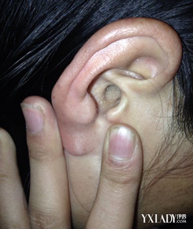 【图】耳垂长痘痘的原因分析 9个方法让你远离耳垂长痘痘的痛苦