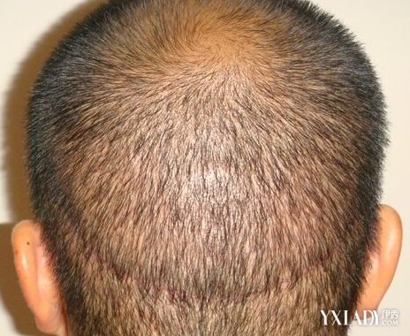 【图】请问脱发看什么科? 7种不同类型的脱发