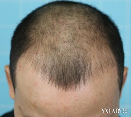 【图】种植头发可靠吗? 专家带你走进科学真相