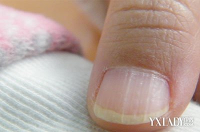 指甲纹成因是什么 教你如何从手看健康