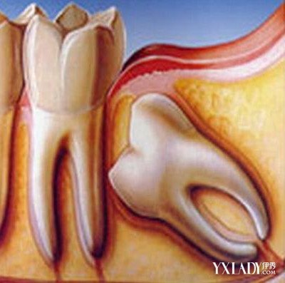 【图】长智齿的症状图片出炉 揭示智齿的生长过程和症状