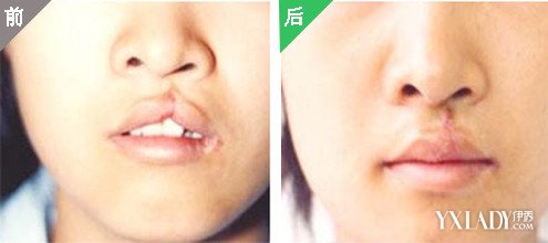 唇裂二期修复 效果如何三大种唇裂修复供你选择