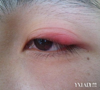 【图】上眼皮红肿发痛 你知道原因及防护方法吗?