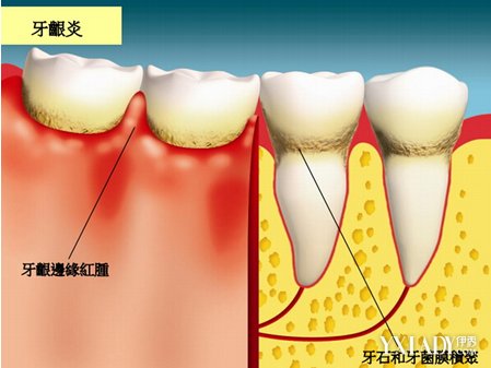 【图】揭秘牙菌斑图片 3种简单方法让你笑容更美