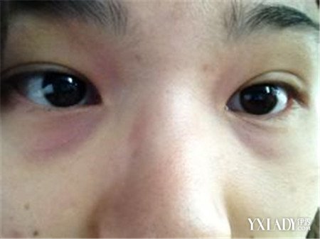 【图】黑眼圈严重是怎么回事? 4个主要的原因