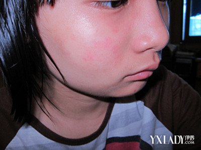 【图】脸上过敏长红疹图片介绍 5大步骤轻松还原健康皮肤