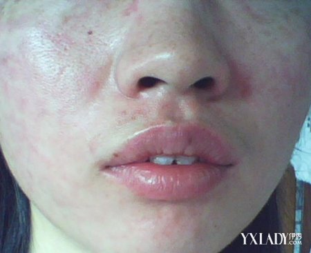 【图】过敏可以喝牛奶吗? 过敏不应该吃的食物