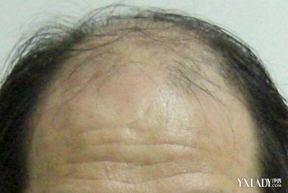 【图】病理性脱发知多少 6种原因可引起脱发(