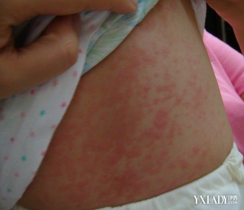夏季过敏起红疹子的图片 三个治疗方法替您解忧