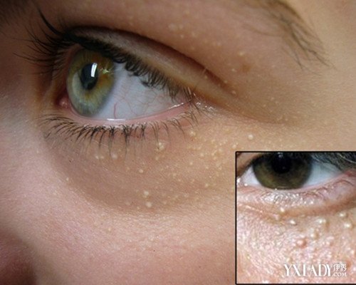 女性眼部脂肪颗粒怎么去掉 出现油脂粒主要有两方面的因素
