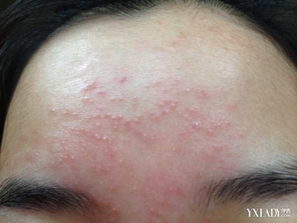 【图】护肤品过敏症状有哪些 5大解决护肤品过敏方法