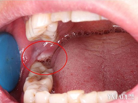 【图】智齿冠周炎自己会好吗 医生建议确诊后应及早治疗