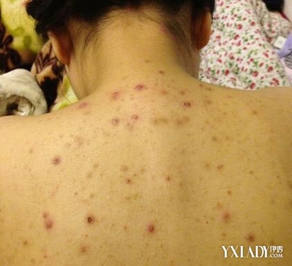 美容 护肤 问题肌肤 / 正文 痘痘又叫痤疮,是一种很常见的皮肤病,痘痘