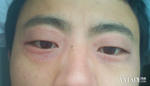 【图】眼睛起皮还痒痒 医生称有可能为湿疹