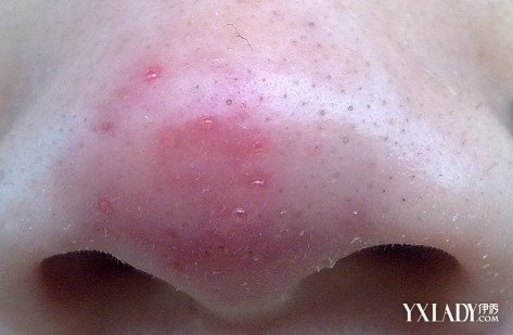 主要表现为鼻子前端发红,鼻翼肥大,有的可发生在两颊部和口的周围.