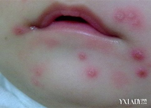 【图】儿童嘴巴带状疱疹图片怎么样 看看医生怎么建议