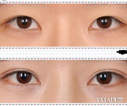【图】双眼皮修复术在什么情况下需要使用 二