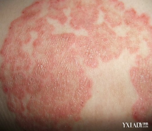 【图】什么是过敏皮肤? 如何呵护敏感性肌肤?