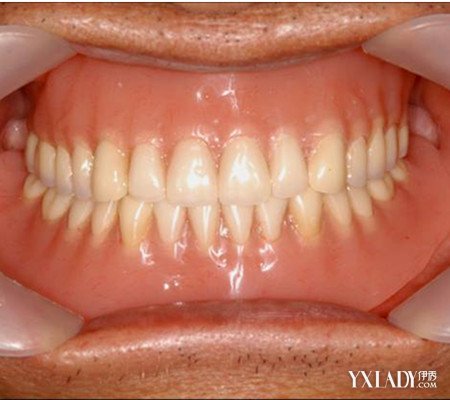 正常的牙槽骨图片 各种美牙秘方为你介绍