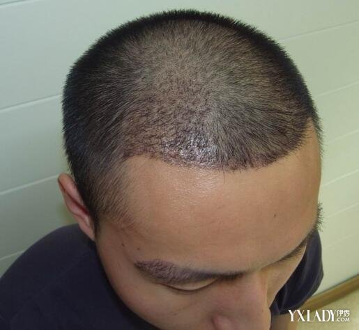 【图】脱发的症状是什么 脱发的各种原因_脱发