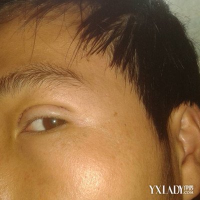 【图】上眼皮肌无力怎么? 治疗上眼睑提肌无力