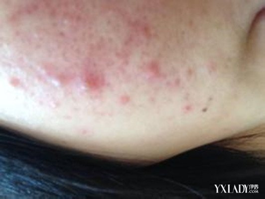 【图】去痘痘的最好方法是什么 10个妙招还你