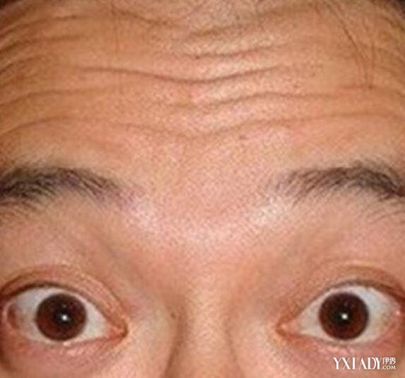 【图】男生额头皱纹怎么消除 6种办法定助你排