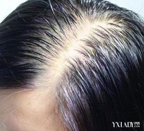 【图】怎样治疗脱发白发 六个食疗法帮你摆脱