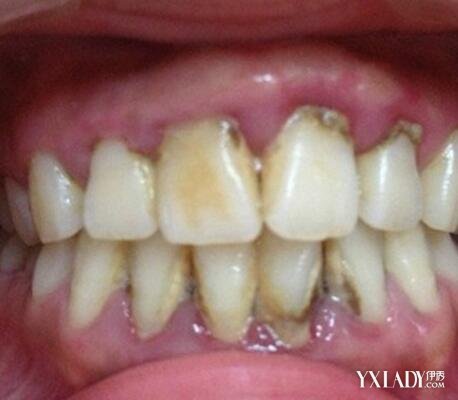 【图】牙石洗牙后牙龈会修复吗 介绍其多种形
