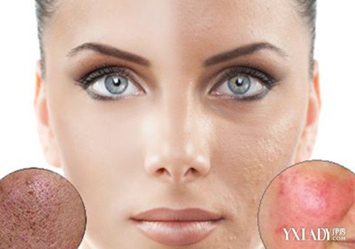 【图】补水可以淡化痘印吗 9个方法简简单单去
