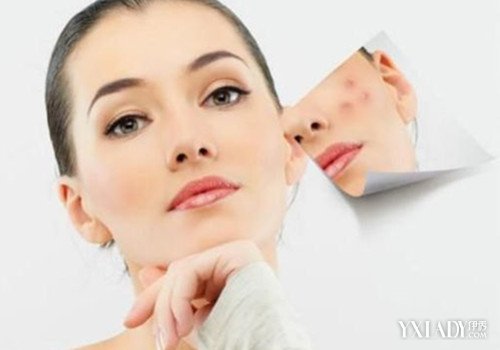 【图】补水可以淡化痘印吗 9个方法简简单单去
