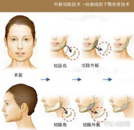 【图】下颌角整形术全过程 术前术后应该注意