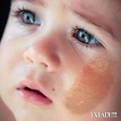 【图】如何去掉咖啡斑 专家告诉你最好的解决