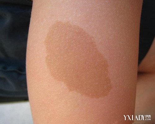 【图】咖啡斑怎么去掉呢 中西医结合治疗还你