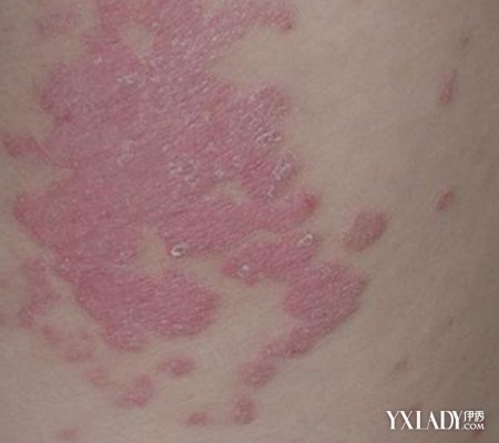【图】红斑丘疹图片分析 教你识别红斑和丘疹的各种症状