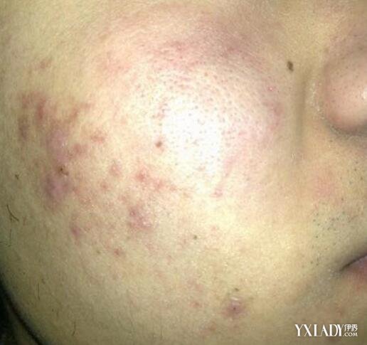 【图】满脸长痘痘的原因有哪些? 多种方法让你