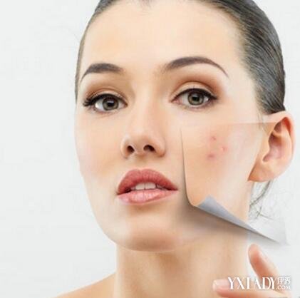 【图】脸上爱长痘痘怎么办? 几点建议帮你解决