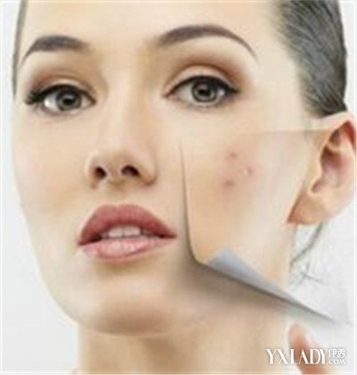 【图】教你怎么把闭口痘痘逼出来 六招轻松解