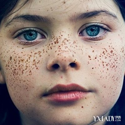 【图】治疗雀斑最好的方法有哪些 7个妙招有效