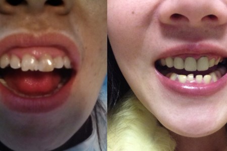 【图】牙釉质损伤修复方法详解 不容忽视的口腔问题应